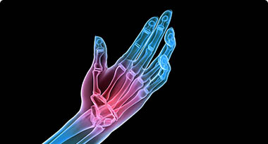 An image of a hand where red indicates the pain area