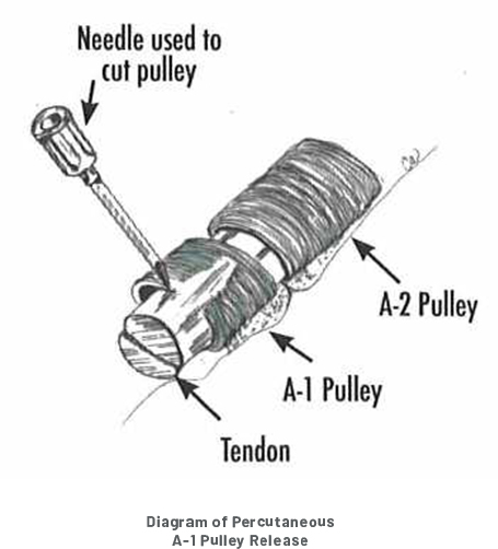 A Diagram of Percutaneous Pulley Release