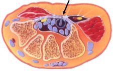 A diagram of Endoscopic Carpal Tunnel Cross Section of Wrist