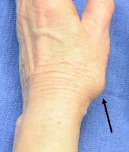 base of the thumb enlarged