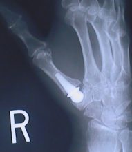 X-Ray of a Pyrocarbon Implant
