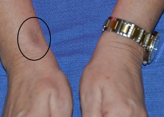 De Quervain's Tendonitis Treatment Nebraska Hand & Shoulder Institute