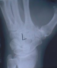 X-Ray Before Tight Rope Suspension Surgery
