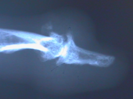 An MRI of a Advanced Degenerative Arthritis