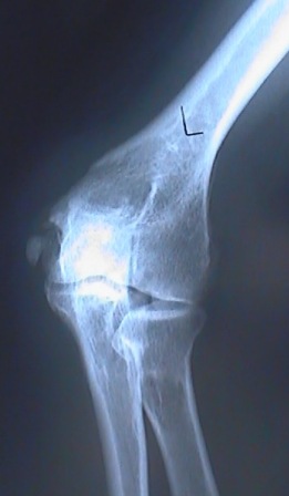 A MRI of a knee