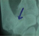 A MRI of arthritis inside a thumb