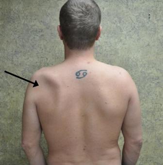 An arrow pointing to the Atrophy where the back of the patient is indented on one side and is fine on the other