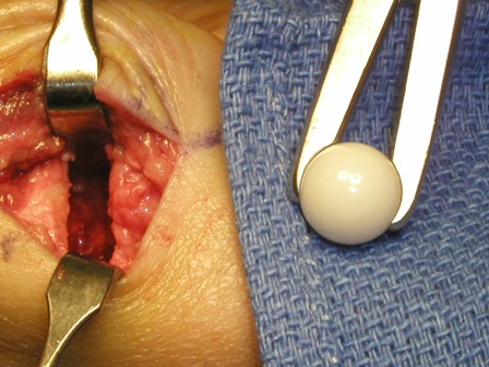 An implant being placed inside a patient