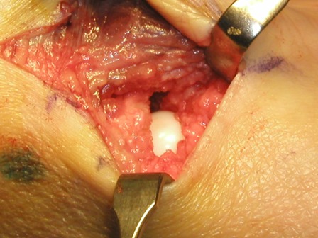 An implant being placed inside a patient