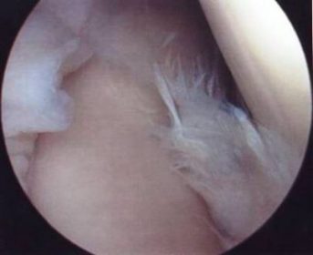 Complex Labral Tear image