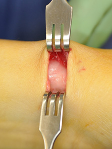 A surgical opening where the foreskin of a knee is peeled back revealing internal flesh