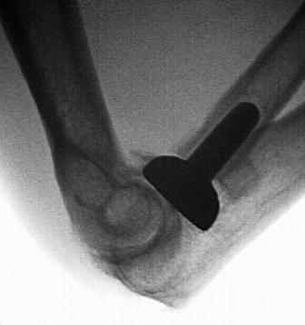A MRI of an elbow with metal inserted