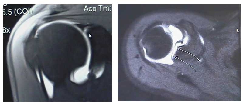 A MRI of a label tear