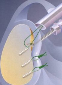 A diagram of hooks and wires repairing the Labral Tear