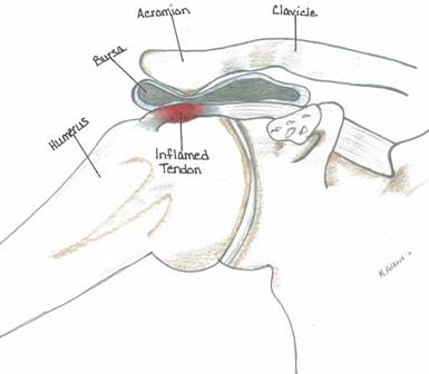 A diagram of Prominent Acromiom where an area is colored red for inflammation