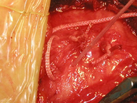 A torn rotator cuff usually occurs after some vigorous forceful activity including a fall. Those in the older age spectrum frequently can't recall any injury. Whether it is because of poor memory or just the fact that their tendon has been decaying slowly and ultimately just snapped is unclear. It appears that there is some of both occurring. There is certainly much better tissue quality to work on in the person who has a traumatic injury to the rotator cuff rather than the person who seems to have a degenerative spontaneous disruption. Controversy remains as to what role the overlying acromion has in the majority of patients with a torn rotator cuff. In some patients there is such a prominent bone developing spontaneously that it appears to rub a hole in the rotator cuff. In these same patients a quick forceful action may act somewhat akin to taking scissors across a tightly held piece of cloth resulting in a tear; people that fit into this category typically have an acromion described as