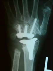 An xray of a hand implant