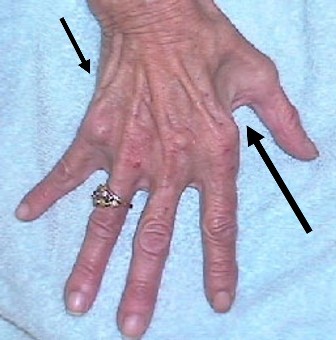 An image of a Hand where Severe Wasting is pointed out using arrows