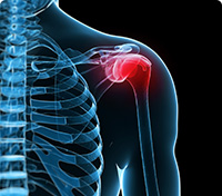 Shoulder of a skeleton where red indicates a specific pain area