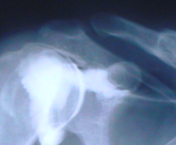 Normal Acromion