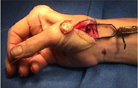 A surgical photo of a tendon joint being reconstructed