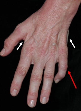 A image with arrows leading to different fingers