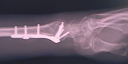 x-ray post op of a wrist fracture