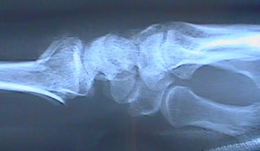 x-ray side view of a fracture