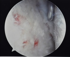 puctate bledeing due to microfracure treatment