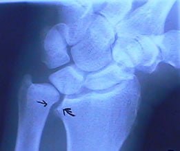 Ulnar wrist x ray