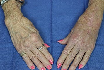 arthritis in woman's hands
