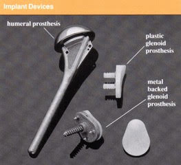 Total shoulder replacement