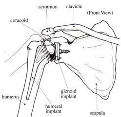 shoulder replacement infographic