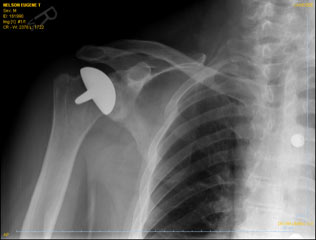 Partial shoulder replacement-Hemiarthroplasty