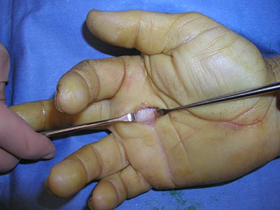 Trigger Finger Surgery on hand