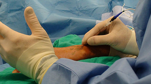 Percutaneus denervation