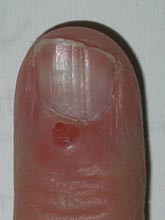 Popped-Cyst-at-Nail-Fold-2