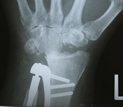 Arthroplasty