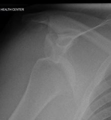 xray of dislocated shoulder
