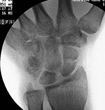 fracture x-ray
