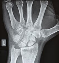 Wrist Fracture x-ray