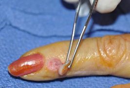 Ganglia Cyst surgery