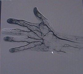 arteriogram for Hypothenar hammer