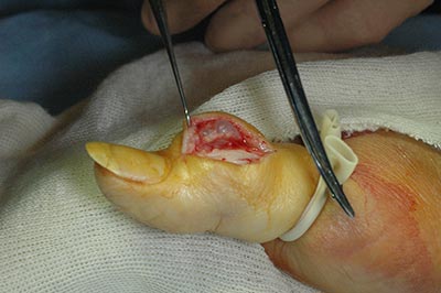 Ganglia Cyst surgery