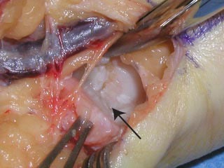 Piso triquetral bone loss