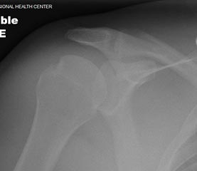 xray of shoulder after reduced