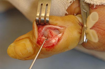 Ganglia Cyst surgery