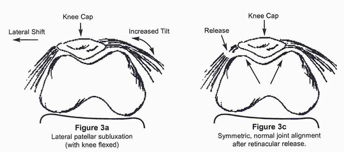 side by side drawings of knee with lateral patellar subluxation and symmetric, normal joint alignment