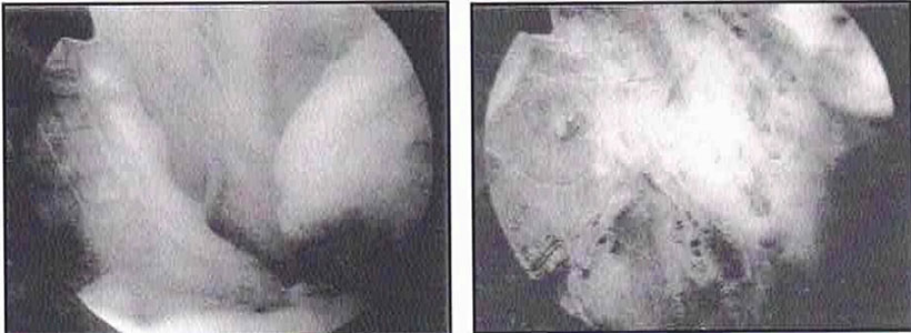 xrays side by side - left showing Pilca and right showing after pilca excised