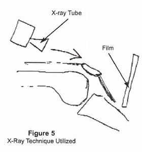 Figure 5 - x-ray Technique used